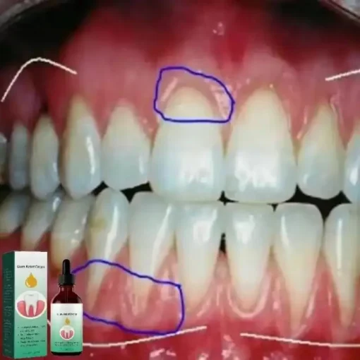 Soro Para Reparo da Gengiva Alivia Gengiva Exposta, Tratamento Amarelecimento Periodontal, Dor na Faringe, Limpeza Bucal, Antibacteriano, Cuidados com os Dentes